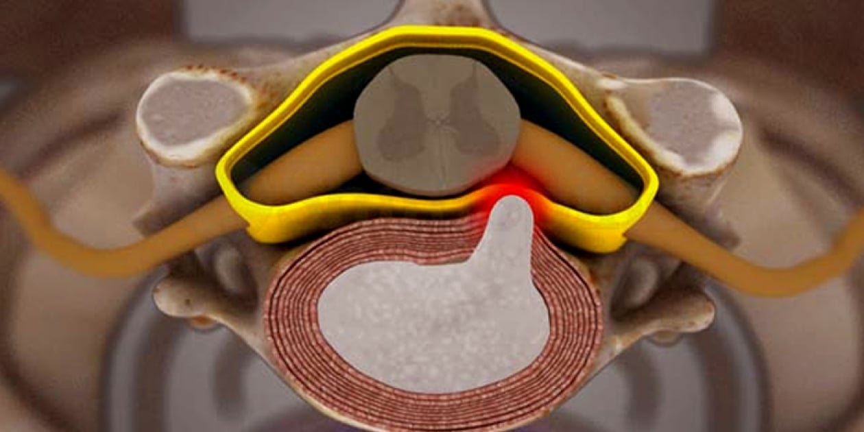 فرق دیسک گردن با آرتروز گردن چیست؟ 6 تفاوت علائم دیسک گردن با آرتروز گردن