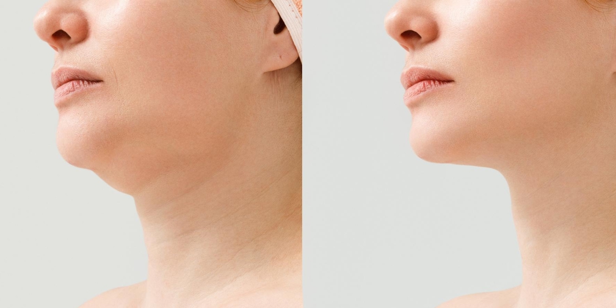 ماساژ برای از بین بردن غبغب